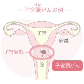 子宮頸がんの例